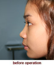 plastic_surgery_augmentation_rhinoplasty